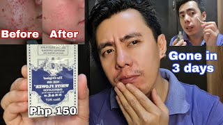 HOW TO CORRECTLY USE WHITE FLOWER LINNIMENT OIL WITH SALICYLIC ACID FOR ACNE OR PIMPLE & SCARS