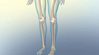 Understanding Osteoarthritis vs. Rheumatoid Arthritis