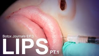 FREE LIP INJECTIONS! | Botox Journals - Ep 3 | Pt.1