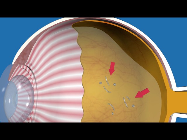 signs of a detached retina signs of a detached retina