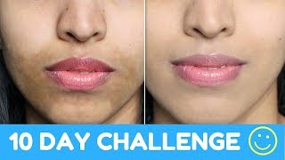 How To Get Even Skin Tone Naturally (Powerful Home Remedy)| Hyper Pigmentation