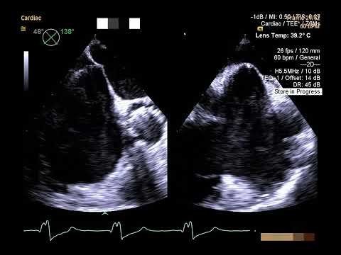 How to echocardiographically guide a trans-septal puncture - PITLOC Protocol