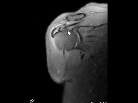 Calcific Tendonitis