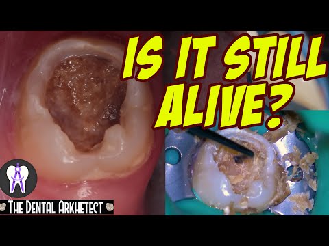 AMAZING Save of A Tooth w/ A Very BIG and DEEP Cavity #4k #C28