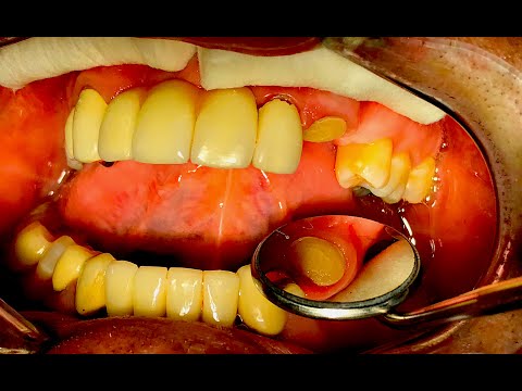 Template Of Tooth