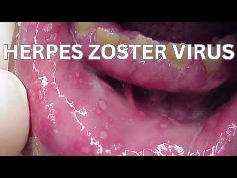 Measles | Herpes Zoster Virus