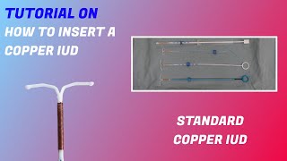 Standard Copper Intrauterine Device (IUD) Insertion