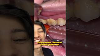 As vezes Não é que seus dentes São Amarelos e Sim Isso… #shorts