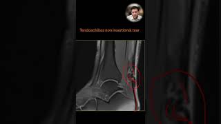 Tendoachilles non insertional tear