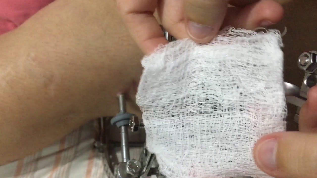 Trocando curativo da gaiola - Alongamento Ósseo