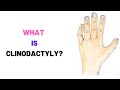 WHAT IS CLINODACTYLY? : Clinodactyly Causes- Symptoms- Treatment- Surgery