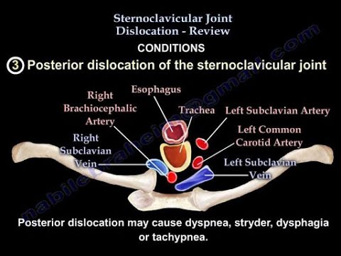 boala sternoclaviculara ce provoacă artroza genunchiului