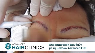 Αποκατάσταση φρυδιών με τη μέθοδο Advanced FUE