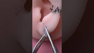 Download lagu Earlobe cancer excision mp3