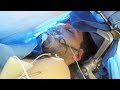 AWAKE BRAIN SURGERY (Uncensored) - Resection ...