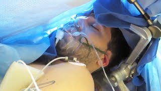 AWAKE BRAIN SURGERY (Uncensored) - Resection of Oligodendroglioma, Right Frontal Lobe