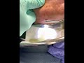 Pus explosion from facial abscess