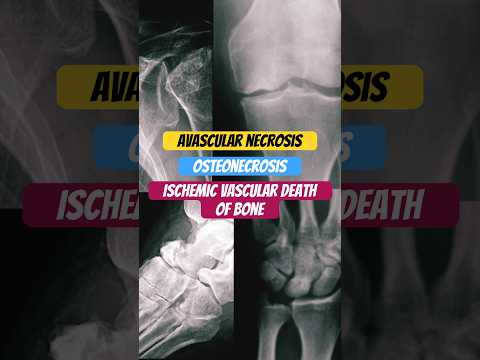 Avascular Necrosis #bones #anatomy #doctor