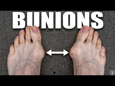 Bunions | Hallux Valgus (Diagnosis, Exercises, Treatment)