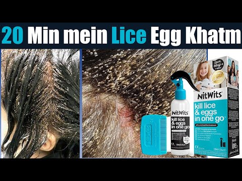 NitWits All-in-One Head Lice Treatment Spray Review, Benefits, Price, Side Effects