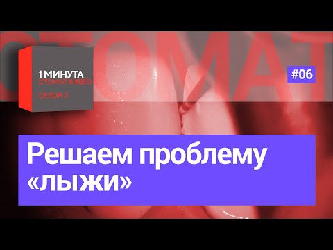 Как решить проблему «лыжи»?