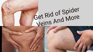 2 Active powders to get rid of Green Veins, Spider Veins naturally & fast