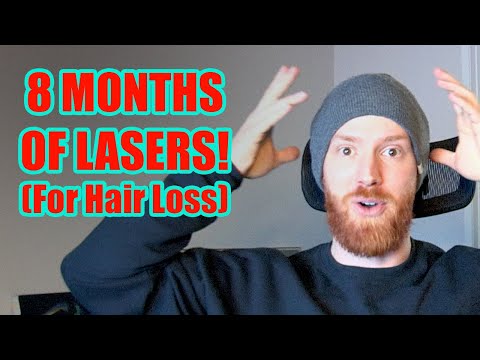 8 MONTH RESULTS from Low Level Laser Therapy (LLLT) for Hair Loss