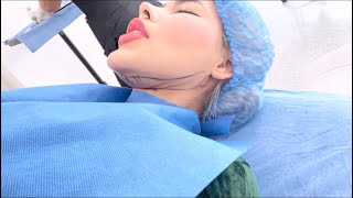 Cirugía de lifting de cuello y lipo papada