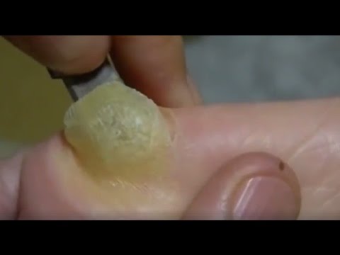 การรักษาโรคสะเก็ดเงินใหม่ Neurodermatitis รูปรักษาปอก