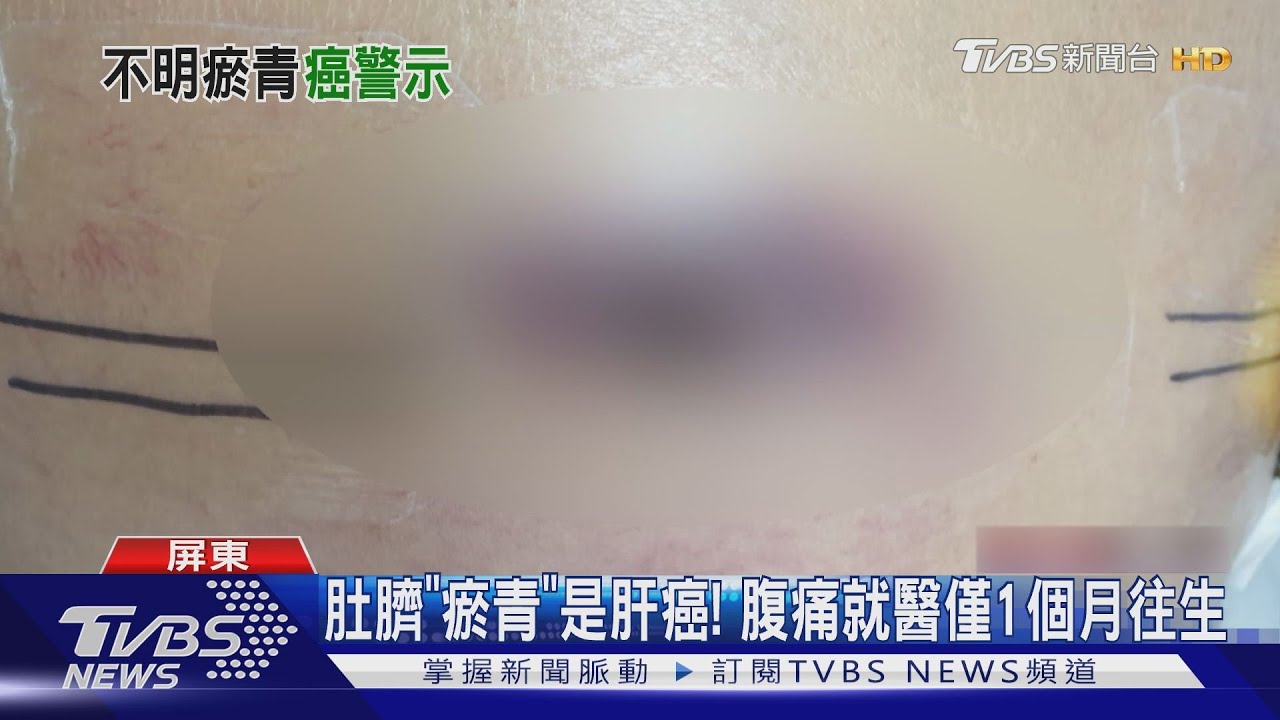 肚臍「烏青」竟是肝癌中末期 腹痛才就醫僅一個月往生
