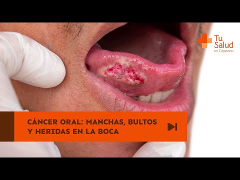 Cáncer oral: manchas, bultos y heridas en la boca | Tu Salud en Cayetano