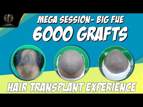 Hair Transplant Mega Session- Big Fue| Best Hair...