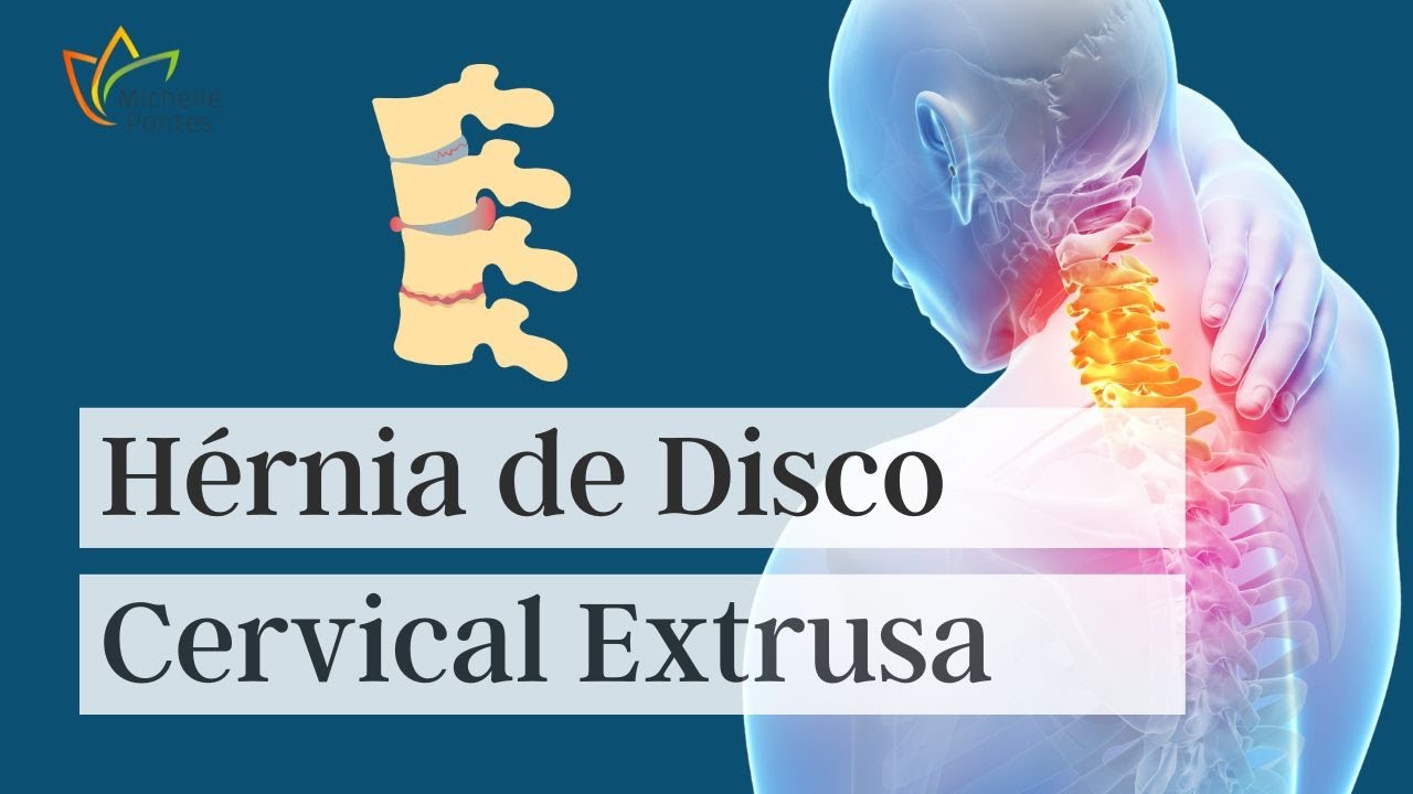 Hérnia de Disco Cervical Extrusa!