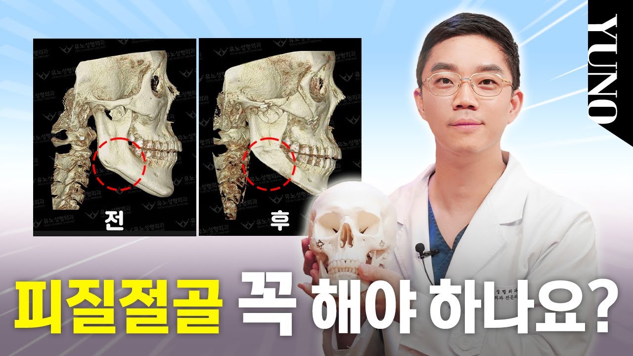 피질절골 꼭 해야하나요??