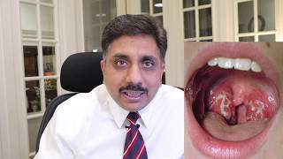 Homeopathic Medicines for Tonsillitis