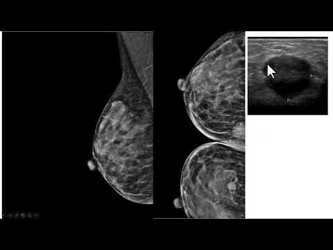 Incidência mamográfica em clivagem em caso de câncer de mama bilateral