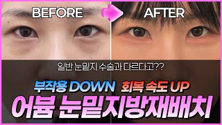 [Eng] 2주만에 다크서클 삭제시키는 어븀 눈밑지방재배치 찐후기🔥Erbium Under-Eye Fat Repositioning