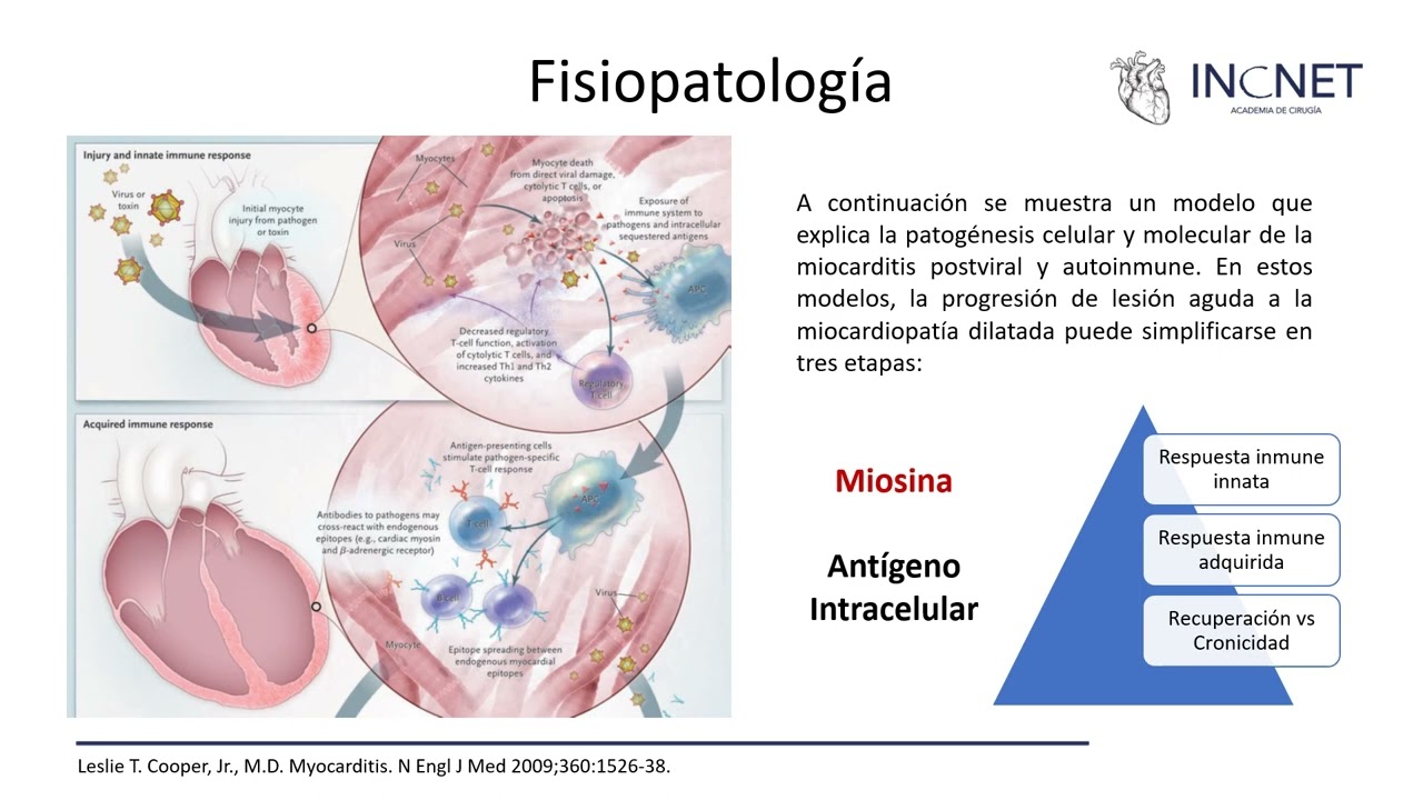Miocarditis y Pericarditis