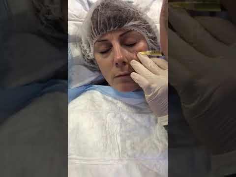 Under eye treatment: Tear Trough Filler. . Dynamic Regenerative Medicine Solihull‬ Birmingham