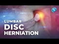 What Is Lumbar Disc Herniation Herniated Disc