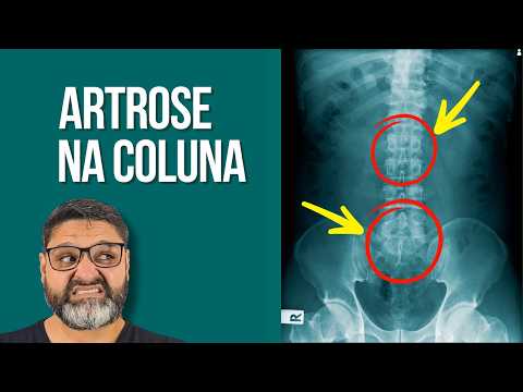 The World's Best Exercise for Osteoarthritis of the Lumbar Spine