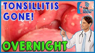 10 Effective Tonsillitis Home Remedies That Work Fast