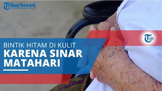 Lentigo, Munculnya Bintik Hitam atau Cokelat pada Permukaan Kulit akibat Terpapar Sinar Matahari