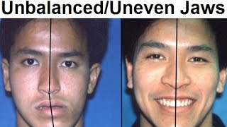 Orthodontic Treatment of Asymmetrical, Unbalanced, Disproportionate, or Unequal Jaw by Dr Mike Mew