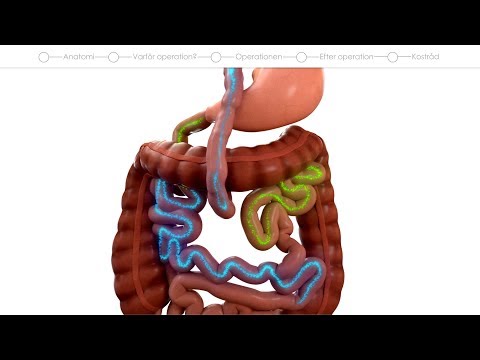 Patientfilm om Gastric Bypass
