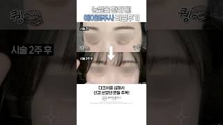 칙칙 다크서클엔 에이빛주사 👀