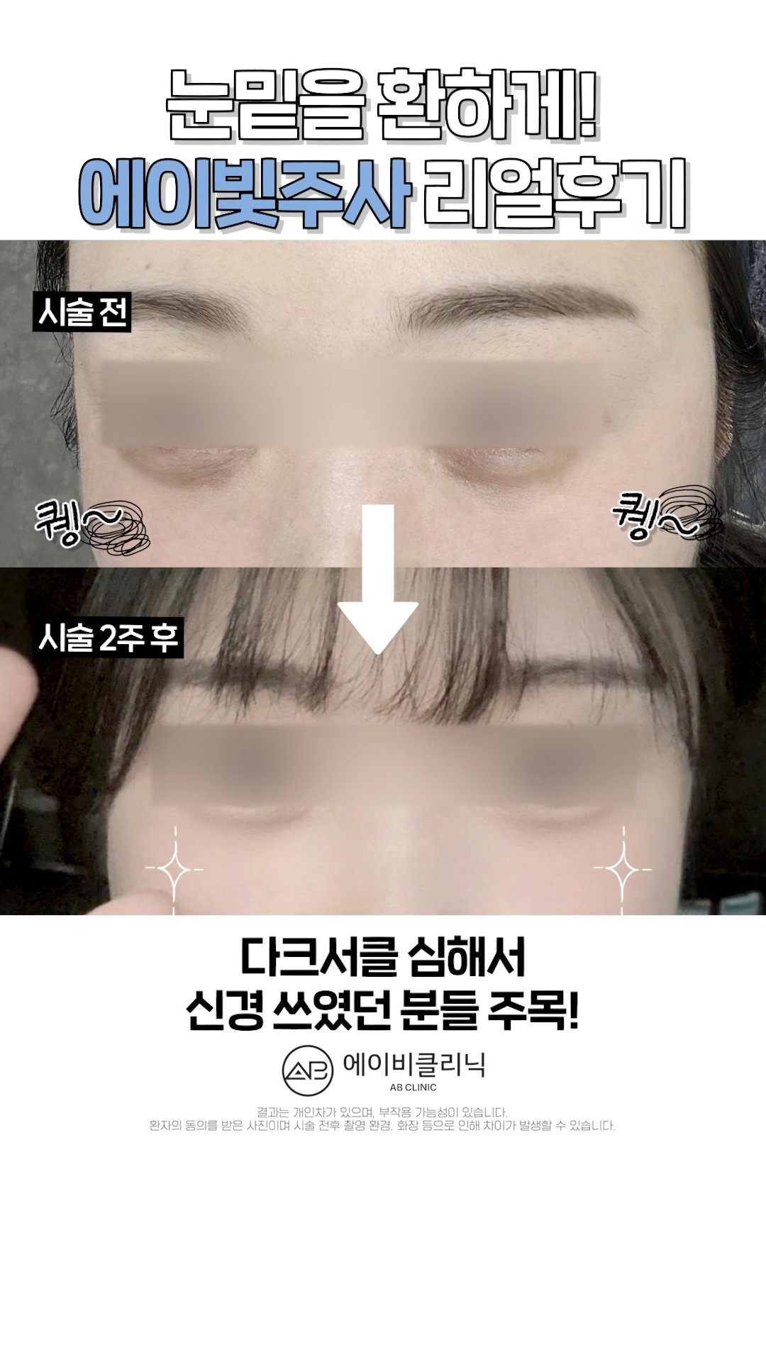 칙칙 다크서클엔 에이빛주사 👀