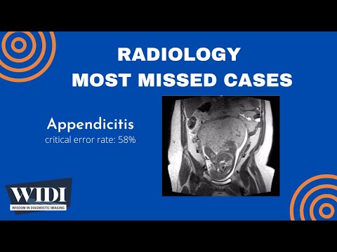 Most Missed Cases: Appendicitis