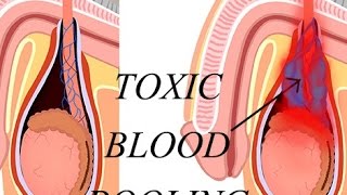 VARICOCELE CURE (EXPOSED!)