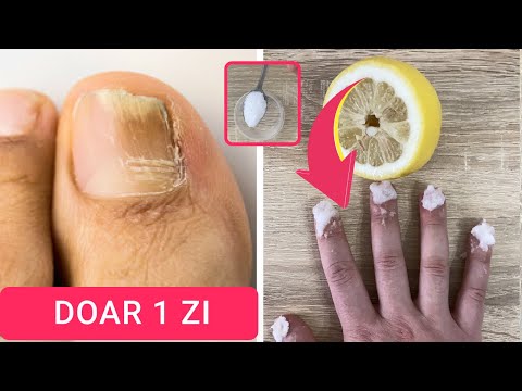 Cum să tratezi ciuperca degetului mare al unghiilor
